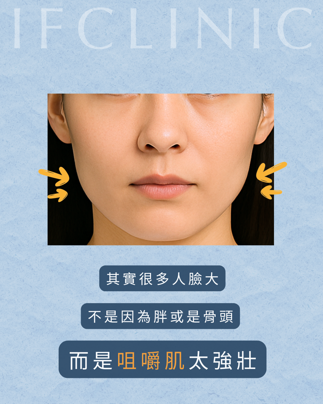 咀嚼肌太壯圖2
