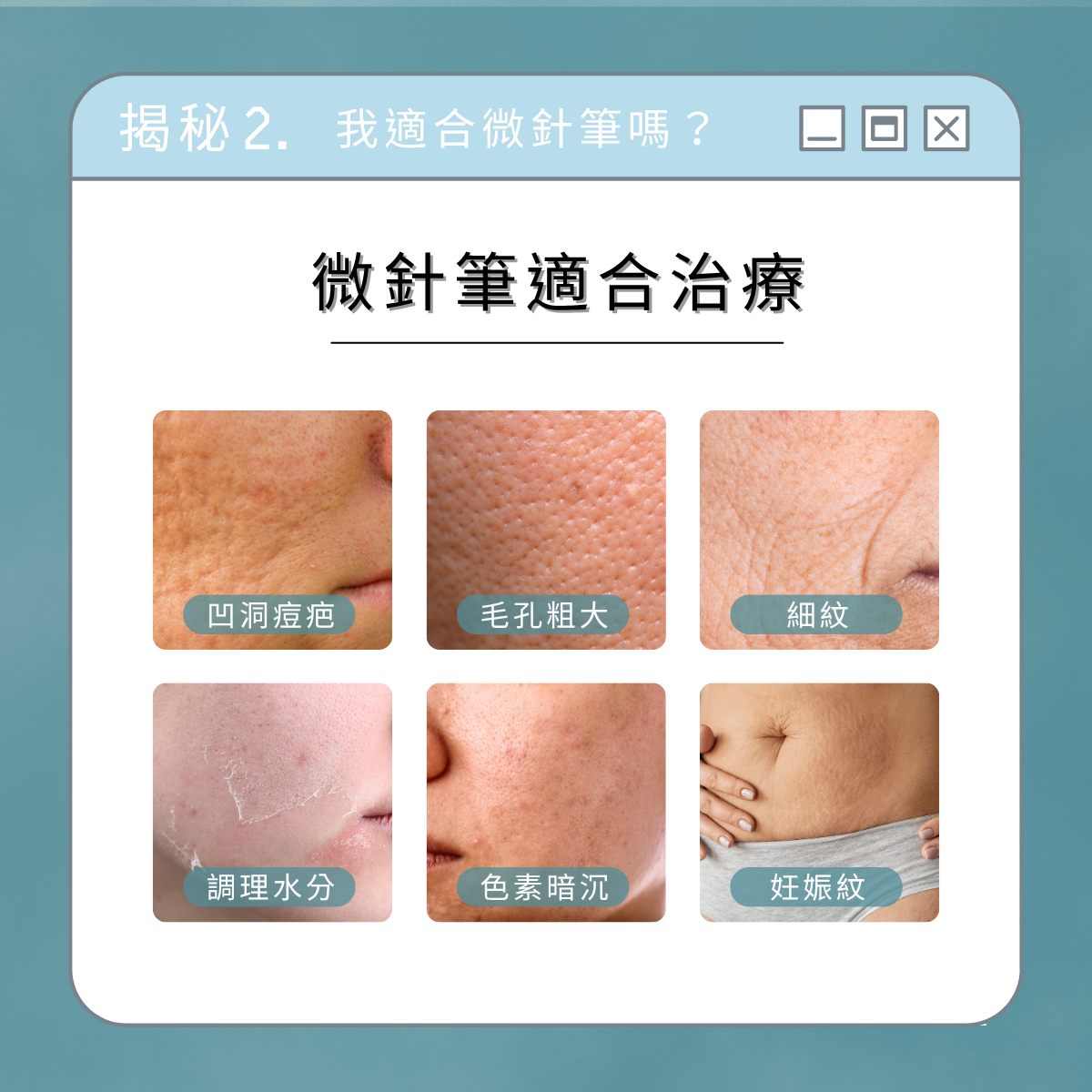 Dermapen 微針筆主視覺圖