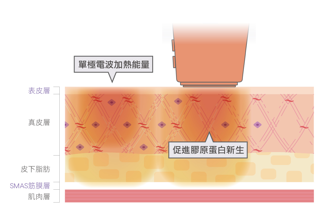 玩美電波治療原理圖