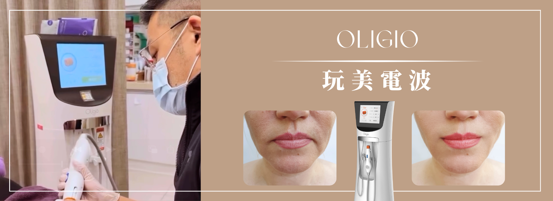 玩美電波,宜芙醫美診所,拉提,鬆弛,嘴邊肉改善,電波拉提,中壢電波